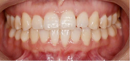 Before